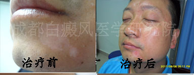 告别白癜风 重新叱咤职场